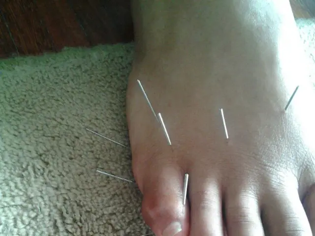 The Mystery Behind Temporary Numbness in Limbs